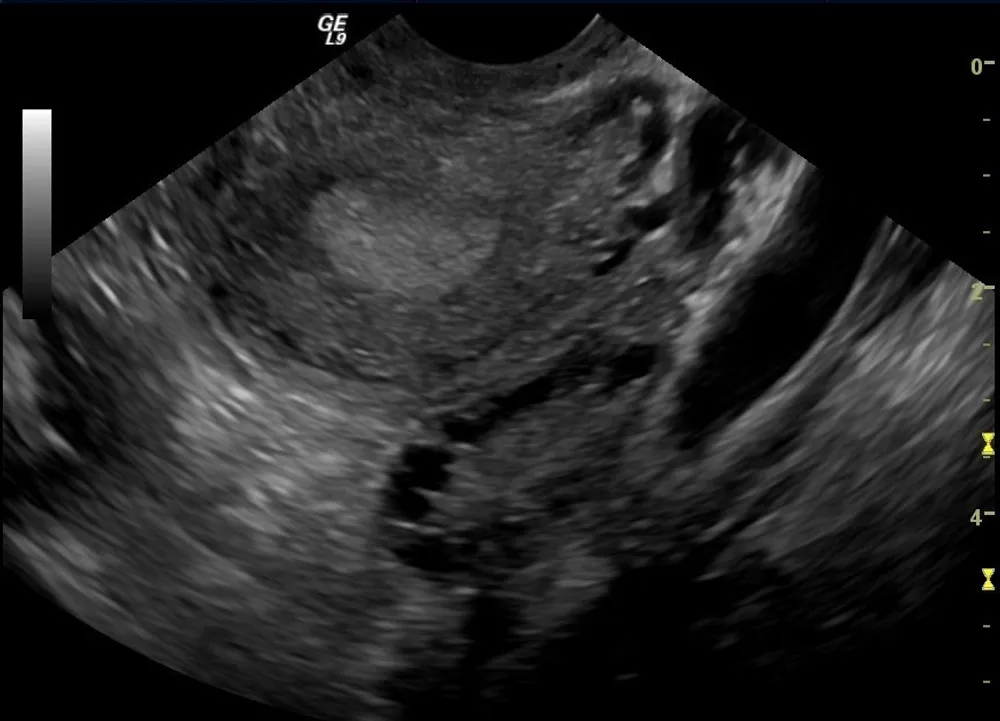 Polycystic_ovary SOPK